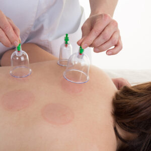CUPPING
